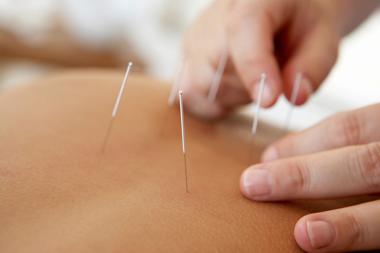 dryneedling